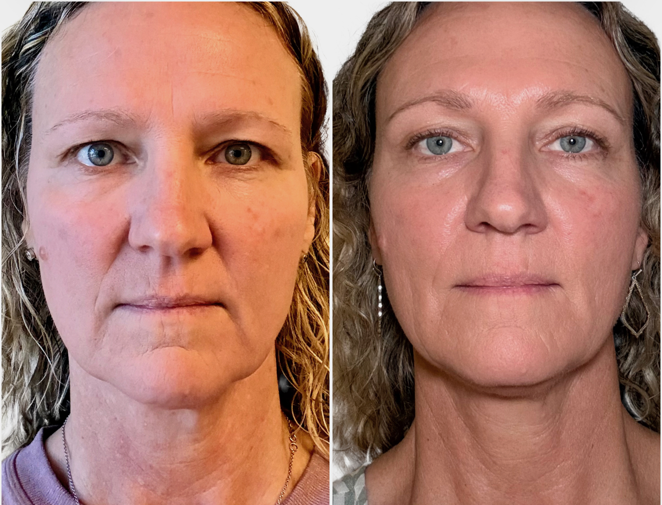 Intelligent Skin Tightening Designed for Comfort